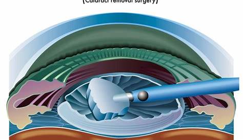 Cataract Surgery Diagram - Mr Shahram Kashani