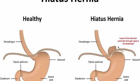 hiatal hernia size chart