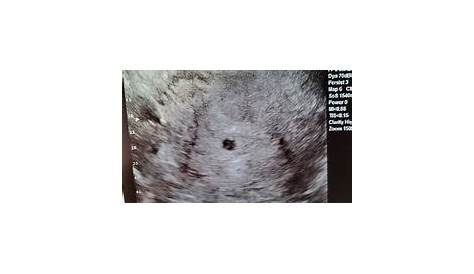 Gestational sac size | BabyCenter