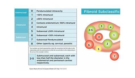 Fibroids - Anthony Siow