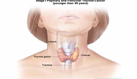stages of thyroid nodules