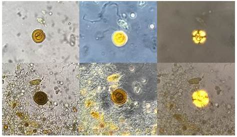 sediments in the urine