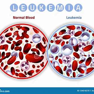Leusemia