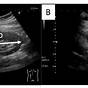 Ultrasound Kidney Cyst Size Chart
