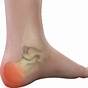 Anatomy Of Heel Pain
