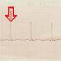 How To Determine Heart Rate From Ecg