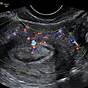 Endometrial Polyp Ultrasound Images