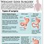 Vsg Weight Loss Chart