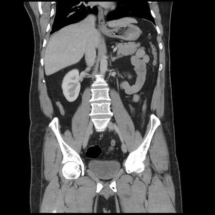 Normal large appendix | Radiology Case | Radiopaedia.org