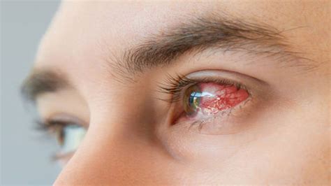 Eye Flu in India: As conjunctivitis cases continue to rise, here's what ...