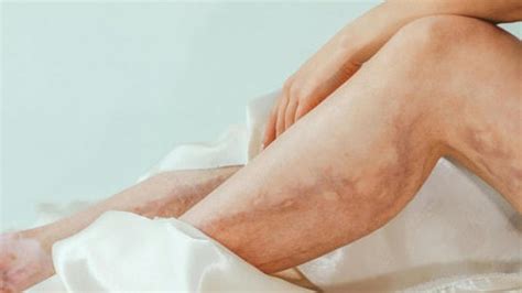 Surgeon explains why women shouldn't ignore leg pain at night ...