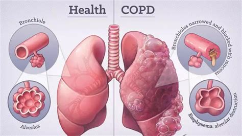 Chronic Obstructive Pulmonary Disease (COPD) in Singapore Take Control ...