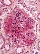 Could enpatoran add to our therapeutic toolbox in SLE? - The Lancet