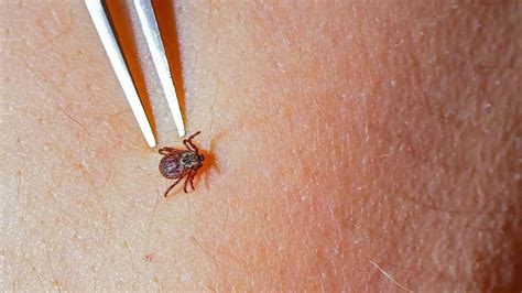 Lyme Disease: Antibiotic shows promise against Lyme disease at a ...