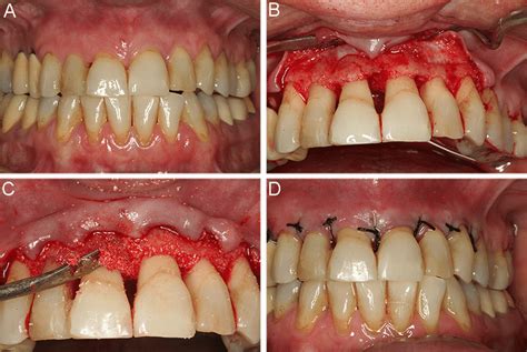 Periodontal Scaling And Root Planing Before And After Slide Share