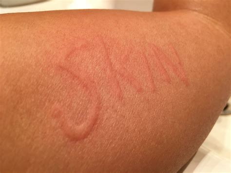 Prevent Dermatographia From Itching Too Much Cottonique Allergy