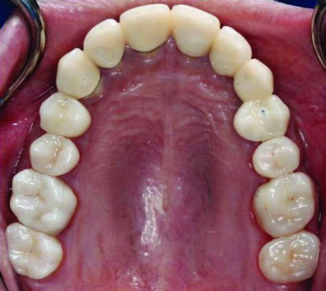 An overview of monolithic zirconia in dentistry. The era of monolithic translucent zirconia Implant Practice US