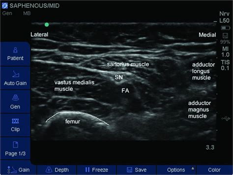 Ultrasound Guided Saphenous Nerve Block Anesthesia Key