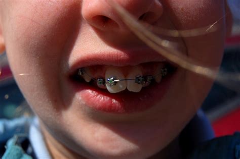 Why use dental wax for braces? Rowan's teeth - with braces | The braces have been put on ...