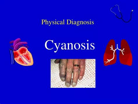 Ppt Physical Diagnosis Cyanosis Powerpoint Presentation Free Download Id1293721