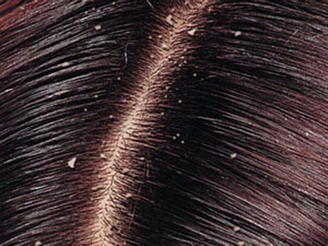 Get Rid Of Dandruff And Dry Scalp Trusper