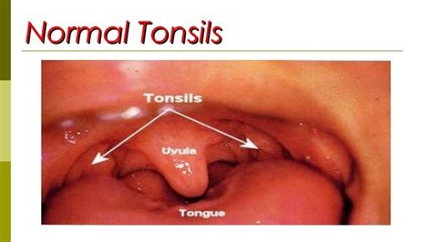 5 Tonsillitis
