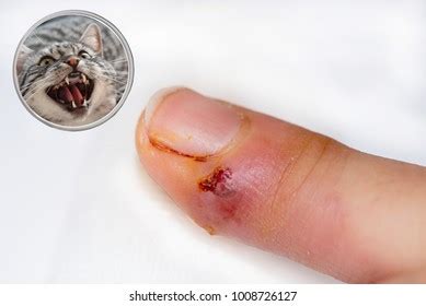 In people who are hospitalized, bacteria may enter through iv lines, surgical wounds, urinary catheters, and bed sores. Sepsis Images, Stock Photos & Vectors | Shutterstock
