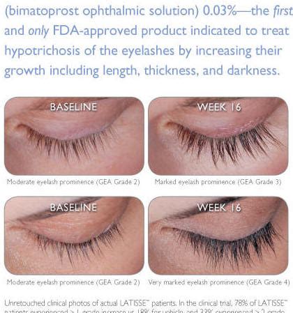 Latisse isn't meant to be applied to the lower eyelid. Latisse Eyelash Growth | Dr. Adams Plastic Surgery