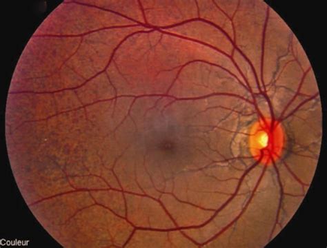 Angioid Streaks And “peau Dorange” Aspect In The Open I