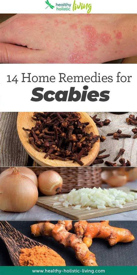 14 Home Remedies To Heal Inflamed And Itchy Skin Caused By Scabies In