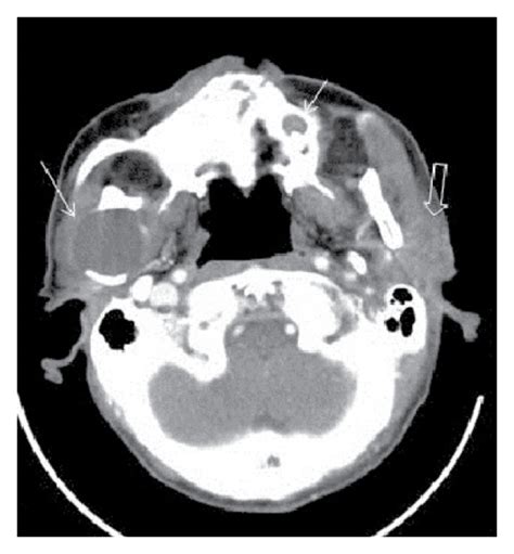 Contrast Enhanced Ct Images Of Neck A Cystic Mass Lesions With