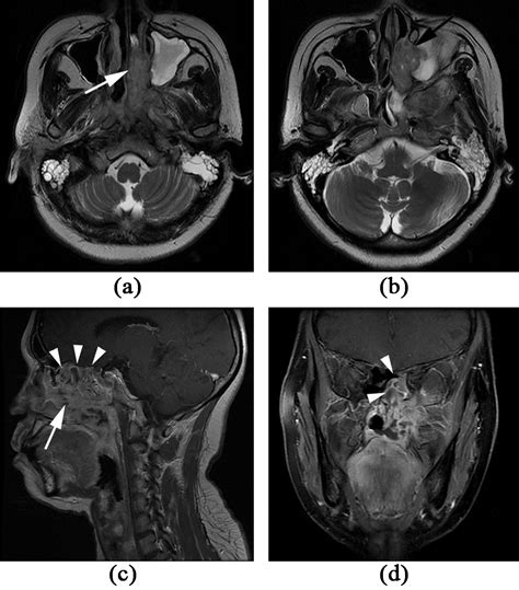 Magnetic Resonance Imaging Features Of Nasopharyngeal Carcinoma And