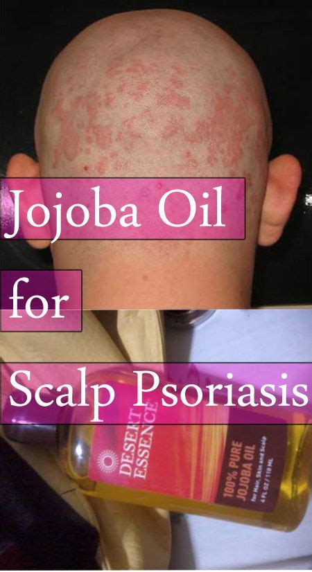 Jojoba Oil For Scalp Psoriasis 3 Simple