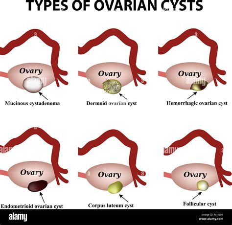 Types Of Ovarian Cysts Set Infographics Vector Illustration On