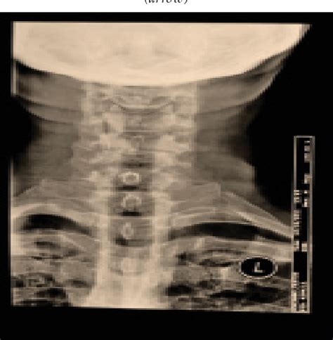 Figure 1 From Tuberculosis Of The Cervical Spine Mimicking A Paraplegic