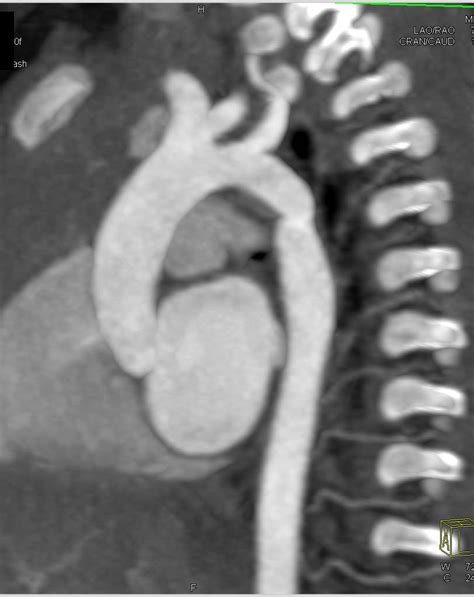 Routine Follow Up Study In A Patient With Coarctation Of The Aorta