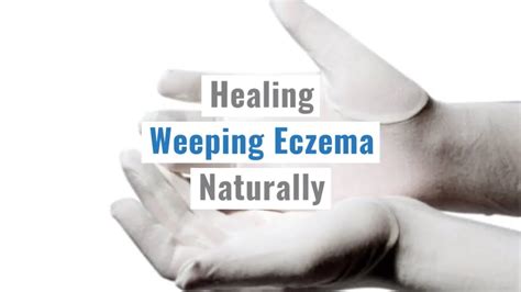Tips For Weeping Eczema Naturally Treating Eczema Naturally Youtube