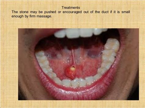 swollen salivary gland under tongue
