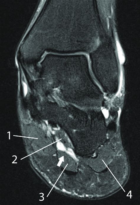 Mri Of The Left Foot In A Normal Patient For Comparison Coronal