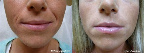 Nasal Fold Filler Before And After