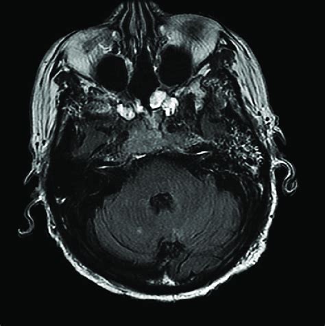 Three Month Post Treatment T2 Weighted Fluid Attenuated Inversion