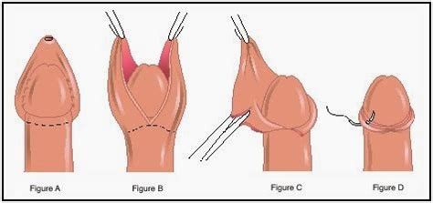 It's important that they take the full dose of antibiotics if it is prescribed. circumcision+diagram - RateMDs Health News