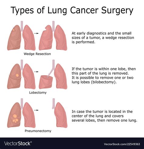 Types Of Lung Cancer Surgery Royalty Free Vector Image