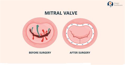 Mitral Valve Replacement Symptoms Diagnosis Procedure Explained