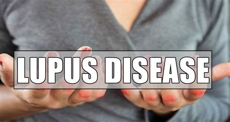 Lupus Disease Symptoms Types And Causes