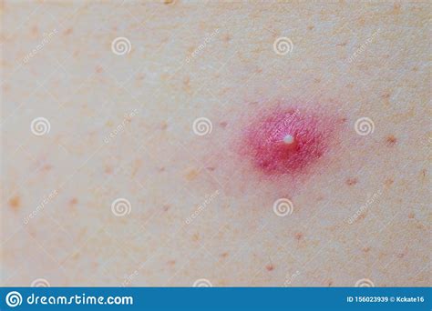 Close Up Photo Of Nodular Cystic Acne Skin Chronic Acne Skin On Woman