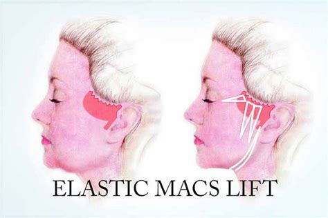 The Elastic Lifting Of The Face And Neck Dr Sergio Capurro