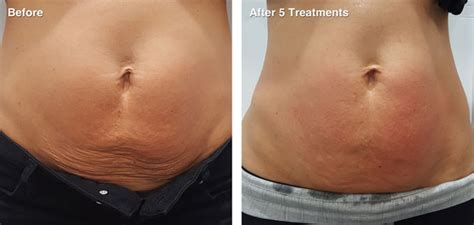 Melt Fat Fast With Rf Fat Melting Cavitation Soho Skin Management