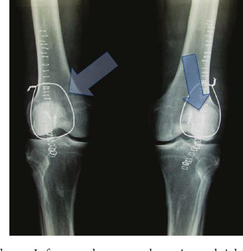 Figure 3 From Simultaneous Bilateral Quadriceps Tendon Rupture In A