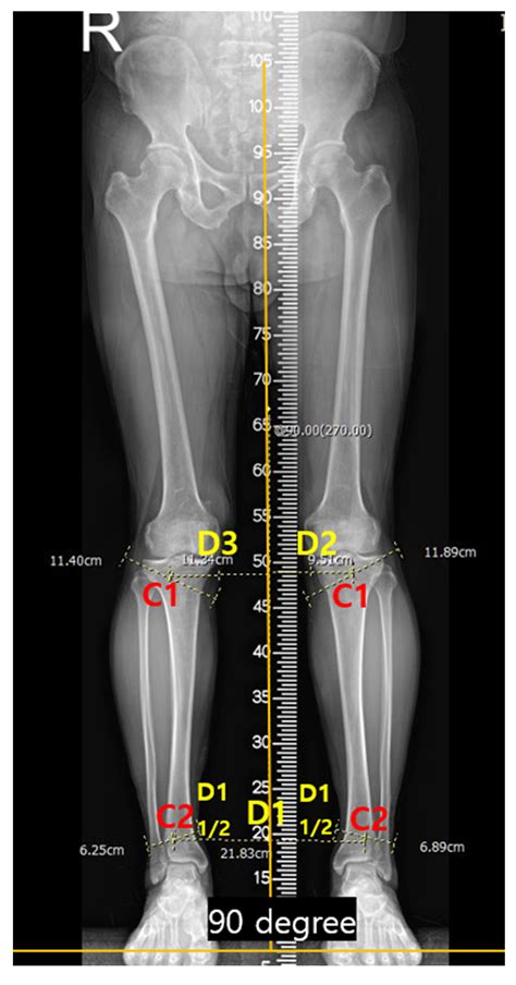 Applied Sciences Free Full Text Measurement Of Lower Extremity Alignment Using A Smartphone
